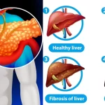 बढ़ रहा है खतरनाक ‘ऑटोइम्यून लिवर डिजीज’ का खतरा, ये लोग हैं निशाने पर, जान लीजिए कैसे बचें?