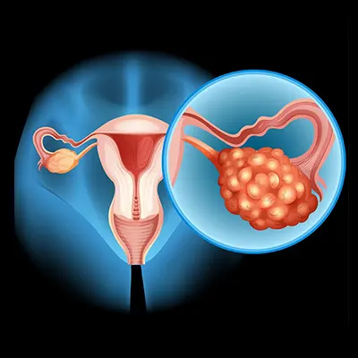 You are currently viewing PCOD: एक गंभीर समस्या, लेकिन समाधान है आपके हाथों में!