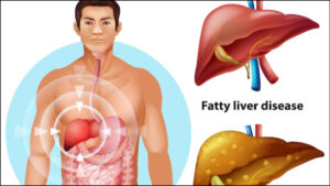 Read more about the article हर तीसरे भारतीय को है फैटी लिवर की समस्या: जानें लक्षण, कारण और लिवर को हेल्दी रखने के टिप्स