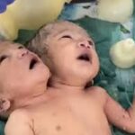 MP में चौंकाने वाला मामला: इंदौर में फिर जन्मी दुर्लभ नवजात, एक शरीर में दो सिर, दो दिल और चार हाथ; डॉक्टर भी हैरान, PICU में चल रहा इलाज!